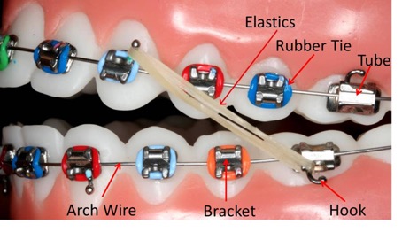 Parts of the Braces