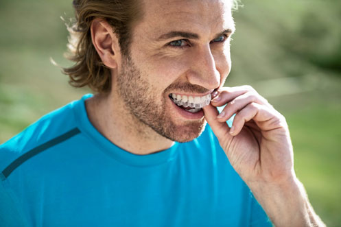 Invisalign Clear Aligners