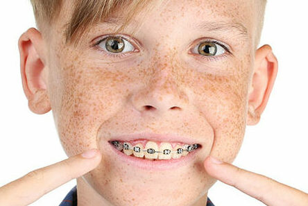 Metal Braces